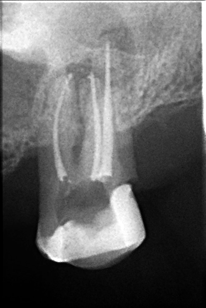 root-canal-treatment-after